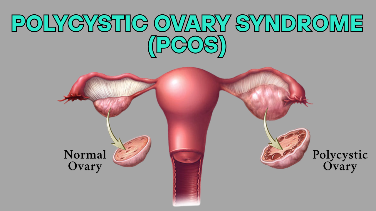 pcos - polycystic ovary syndrom - doctor sahab