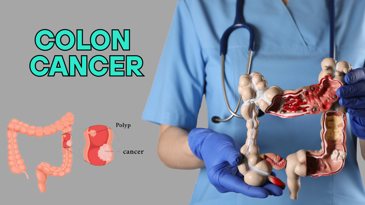 colon cancer - doctor sahabs