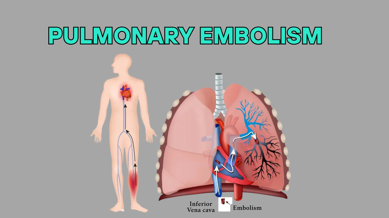 pulmonary embolism - doctor sahab