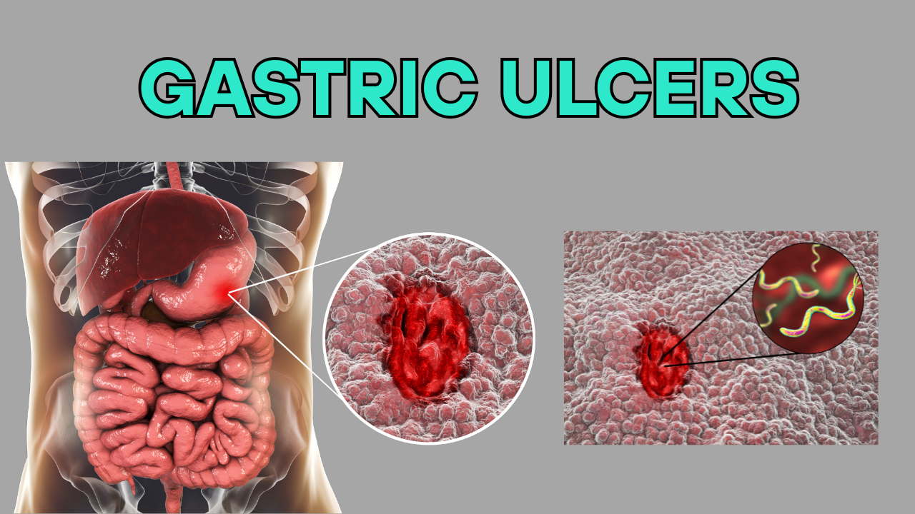 gastric ulcers - doctor sahab